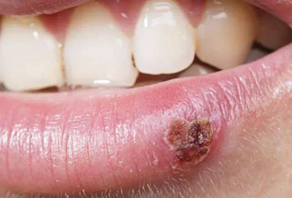 2024年生殖器皰疹攻克進(jìn)展,連貫性方法執(zhí)行評估_VFL27.121便攜版