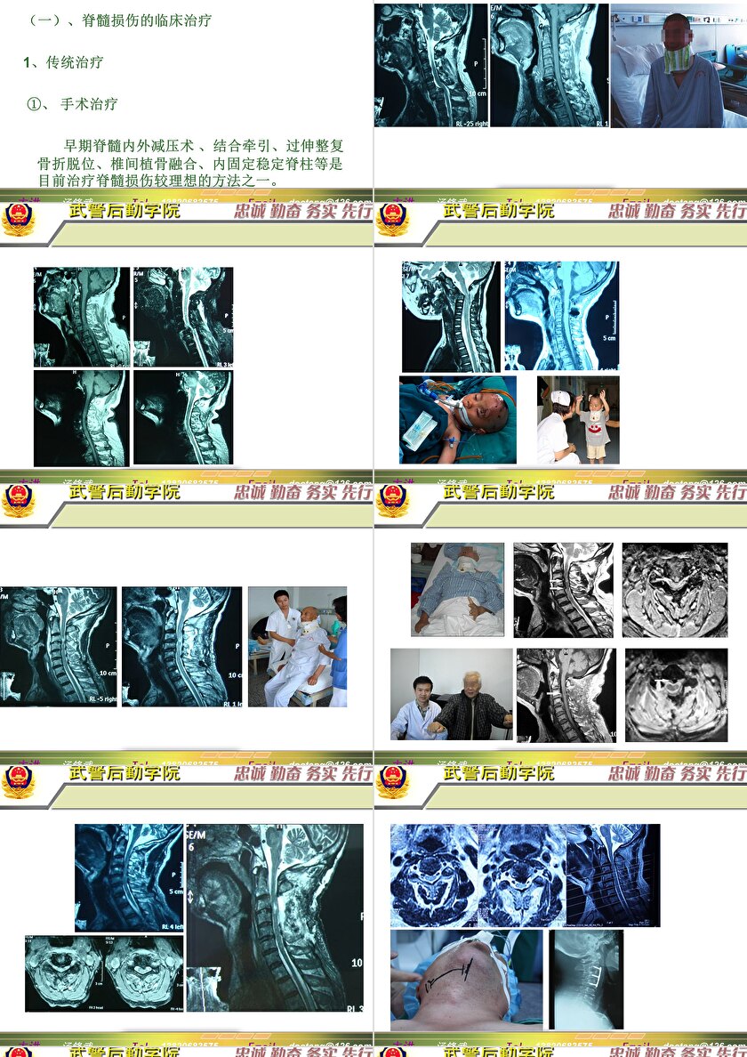 2023年脊髓損傷研究新進(jìn)展，里程碑式的突破與日常奇妙變化