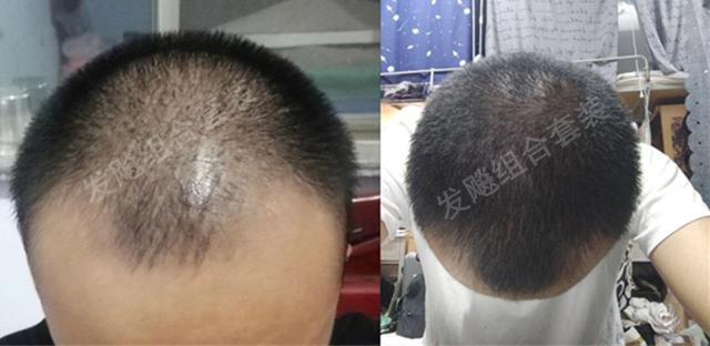 治愈脫發(fā)最新重大突破，重塑自信，希望之光再現(xiàn)