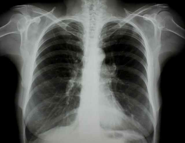 撫順肺炎最新動(dòng)態(tài)與全面步驟指南