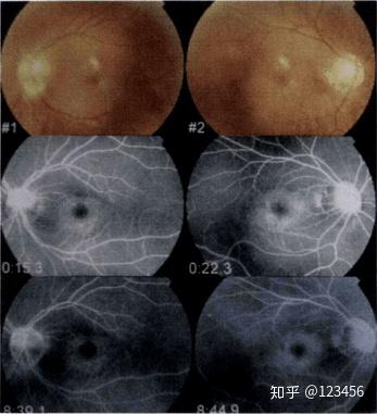最新藥肺炎詳解，你需要知道的一切——健康小紅書